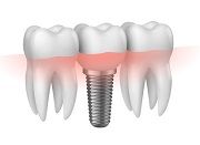 Leistung - Zahnersatz auf Implantaten